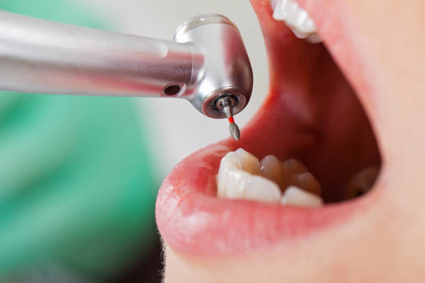 Best Urgent Care for Lost Fillings or Crowns in Forest City, NC